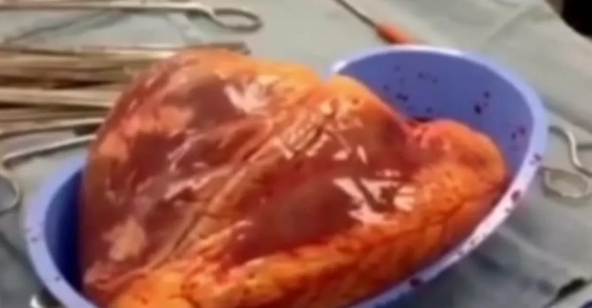 VIDEO: Srdce kokainisty tlouklo mimo tělo ještě 25 minut