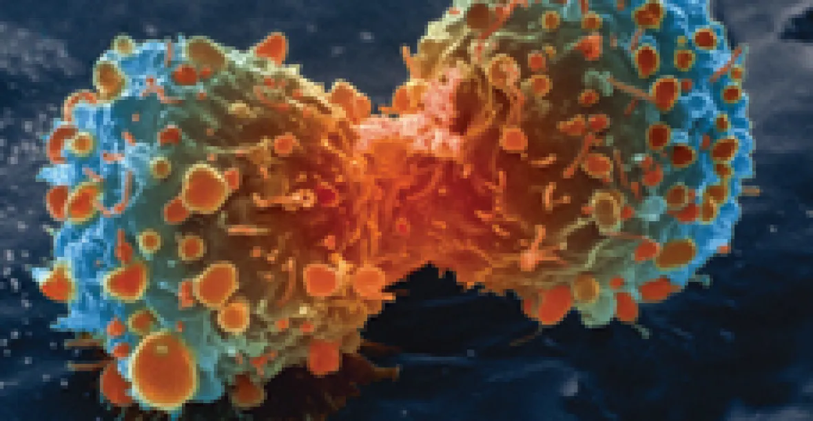 Vědci: Rakovinu v buňkách vypneme. A nádory zmizí