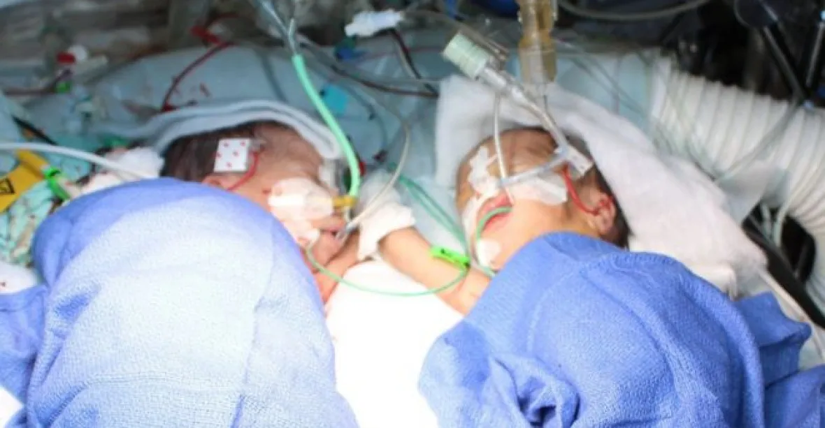 Ve Švýcarsku oddělili nejmladší siamská dvojčata