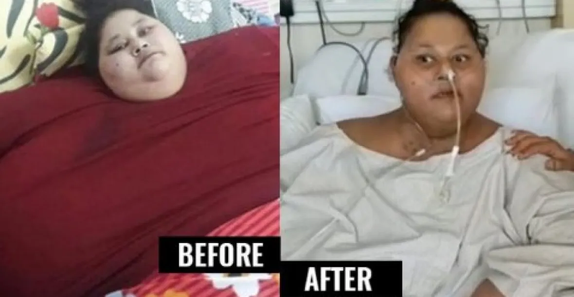 Nejtlustější ženě odoperovali 300 kg, čekají jí další operace