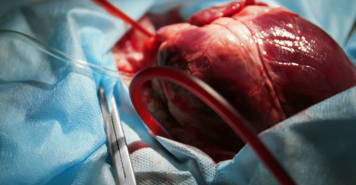 Batole čekalo v Motole na transplantaci s mimotělním mechanickým srdcem