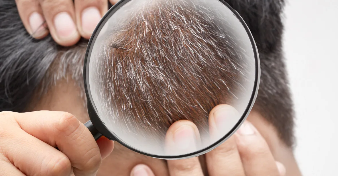Můžou vlasy zešedivět hrůzou? Vědci nově popsali příčinu nezvyklého jevu