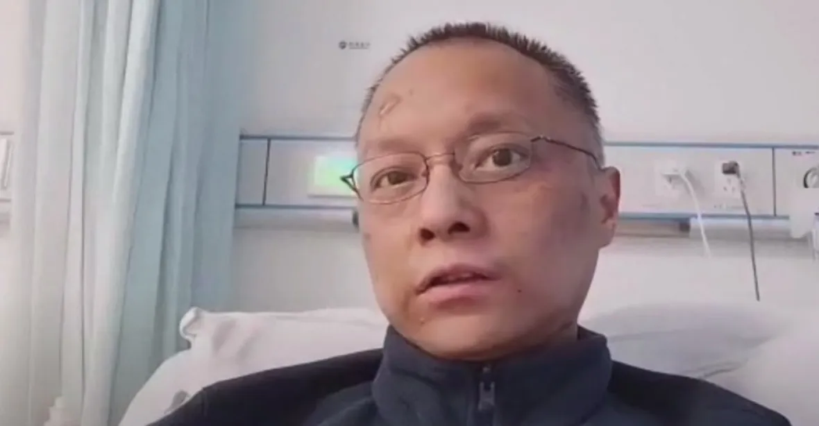 Zemřel čínský lékař, kterému po nákaze koronavirem ztmavla pleť