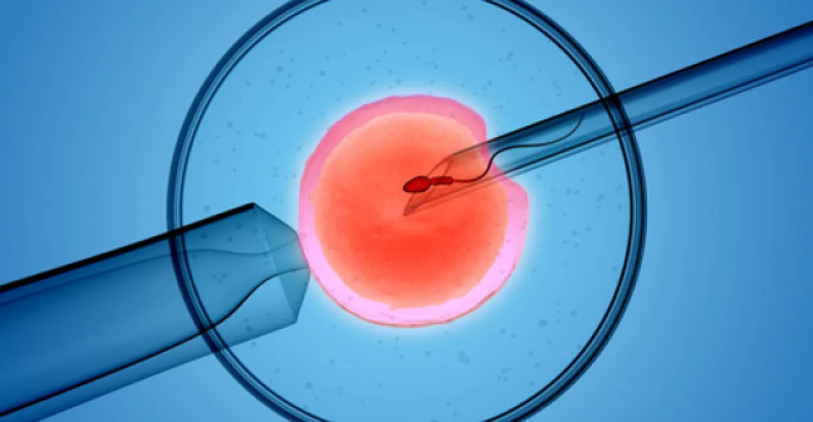 Gynekolog uměle oplodnil nejméně 17 žen svým spermatem