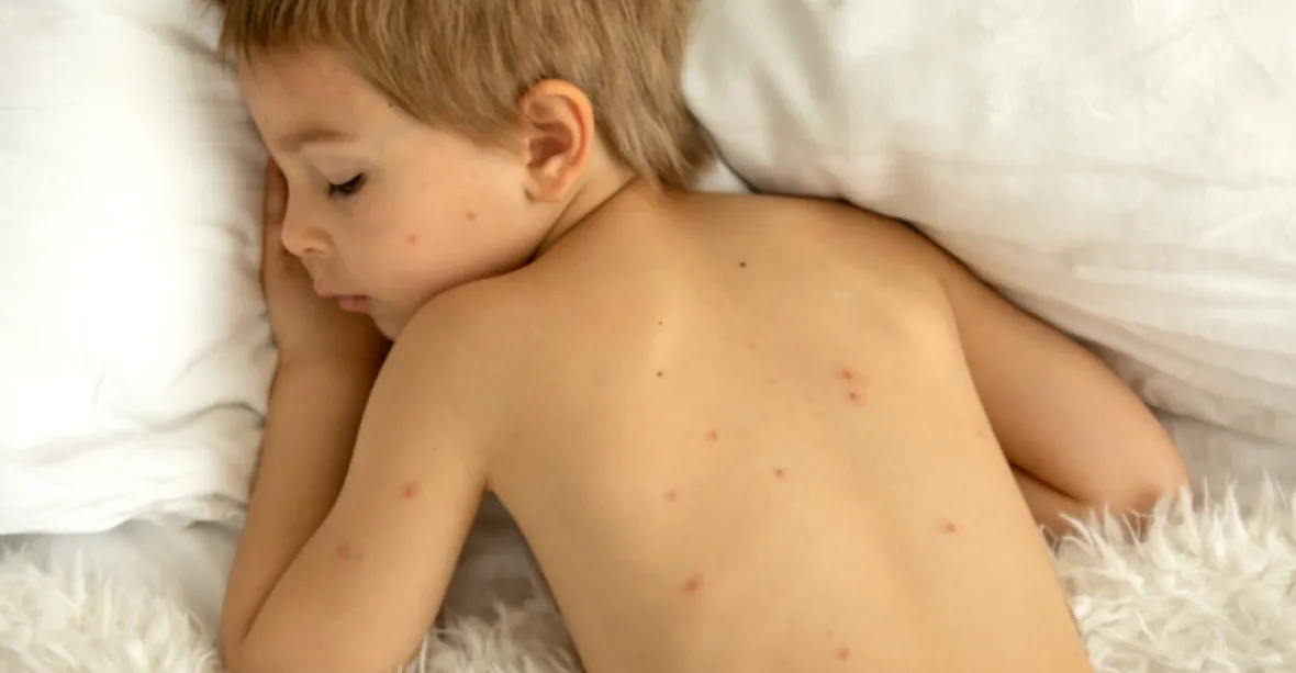 Plané neštovice řádí mezi dětmi až osmkrát víc. Žáci se dva roky nepromořovali