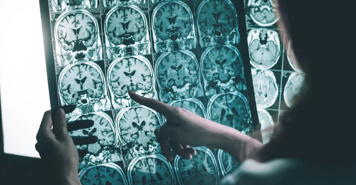 Alzheimer se může přenášet z člověka na člověka, zjistili vědci